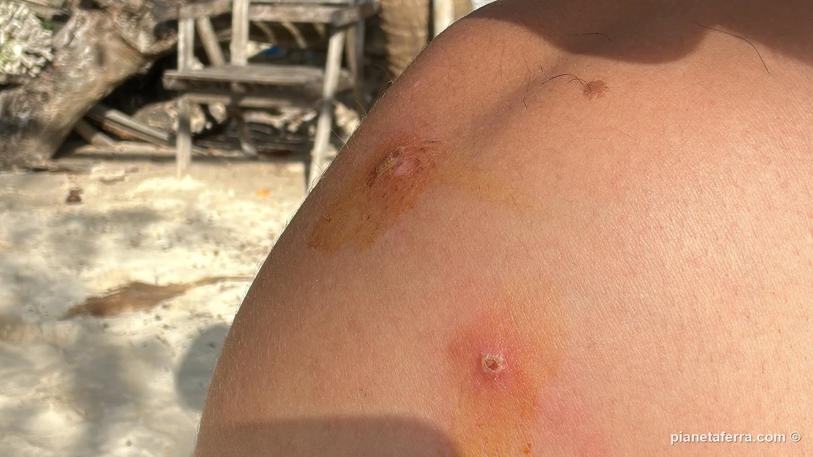 Due punture di zanzara infette sulla spalla di Luca a Koh Tao, nel 2022